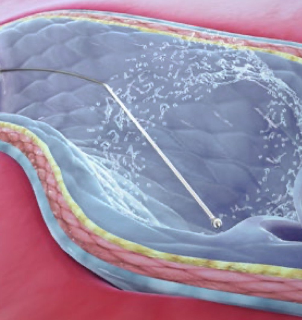 ClariVein<sup>®</sup>-Methode