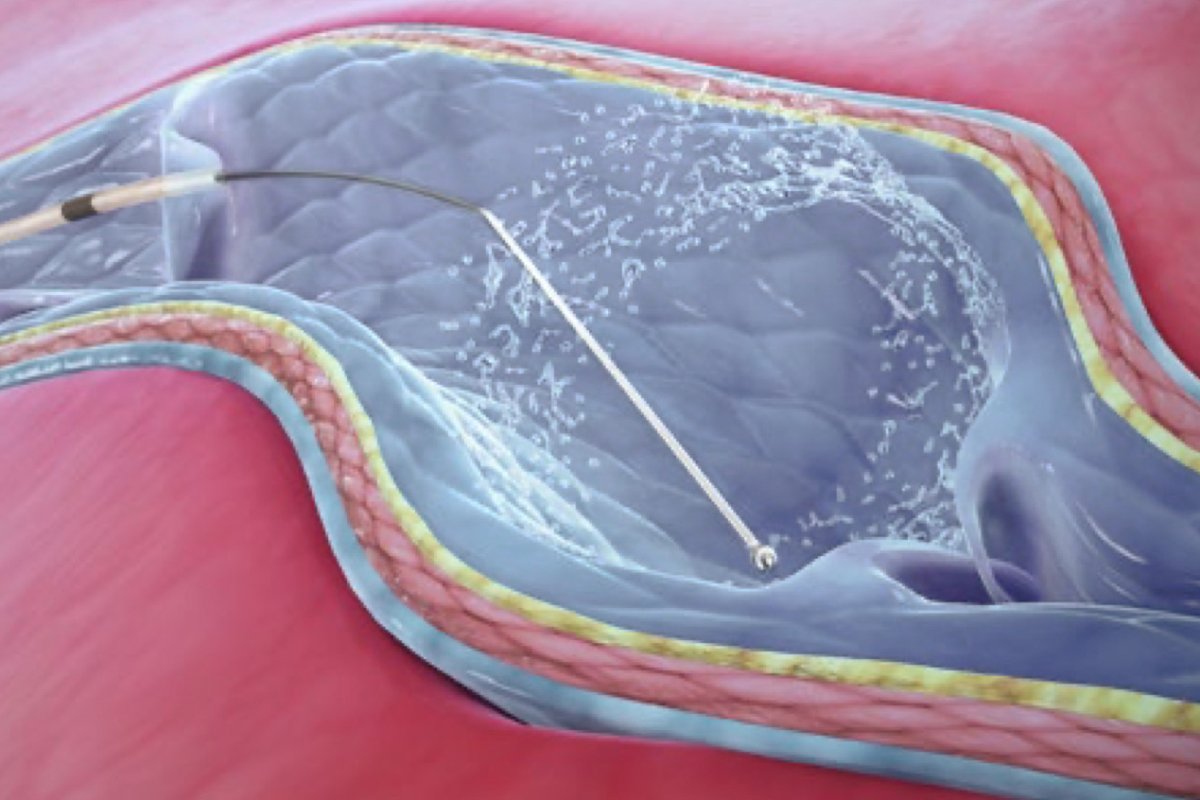 ClariVein<sup>®</sup>-Methode