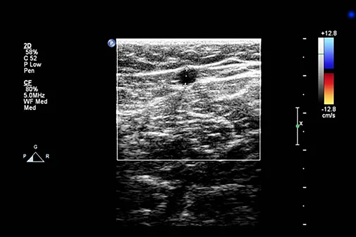 Ultraschalldoppler